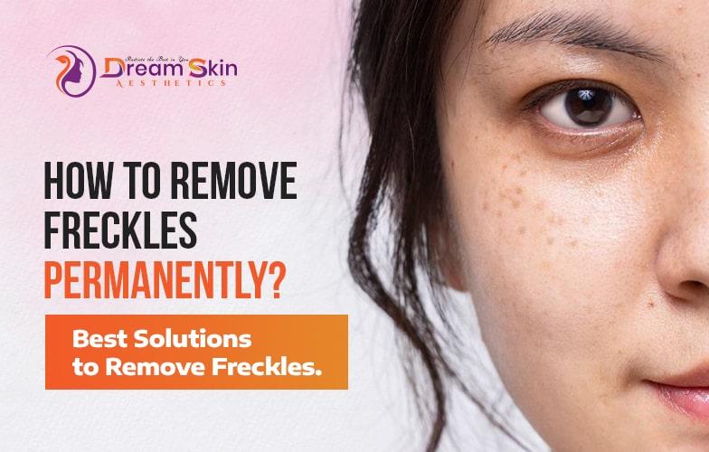 Blog - How to Remove Freckles Permanently? - Best Solutions to Remove Freckles