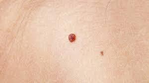 Mole/wart/skin tag removal