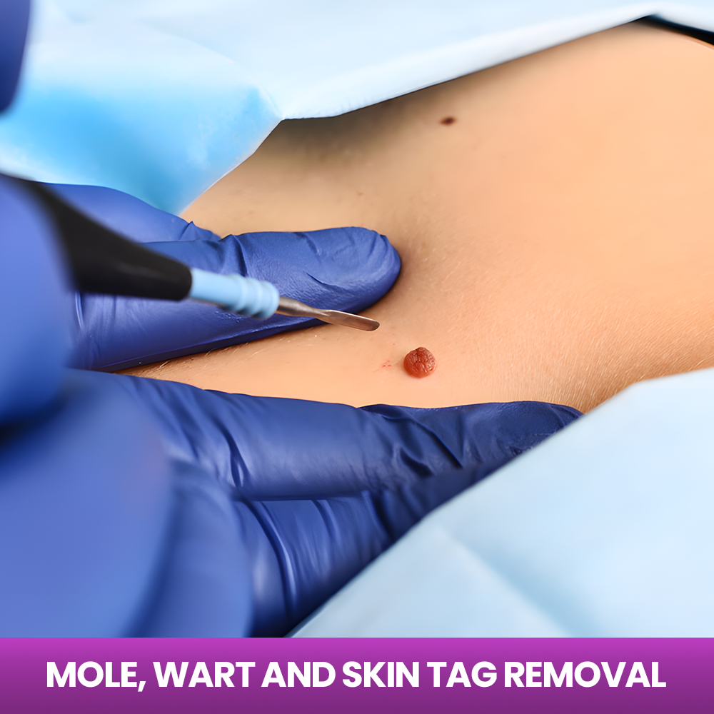 Service - Mole, Wart and Skin Tag Removal