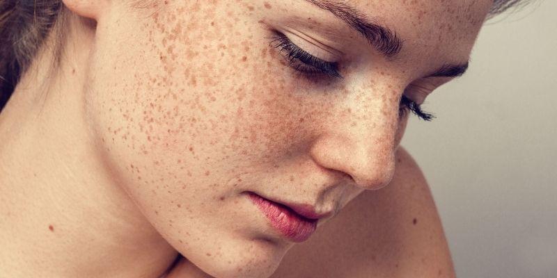 Freckles removal